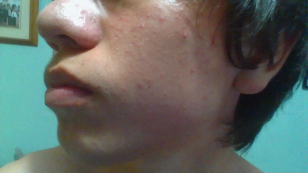acne vulgar