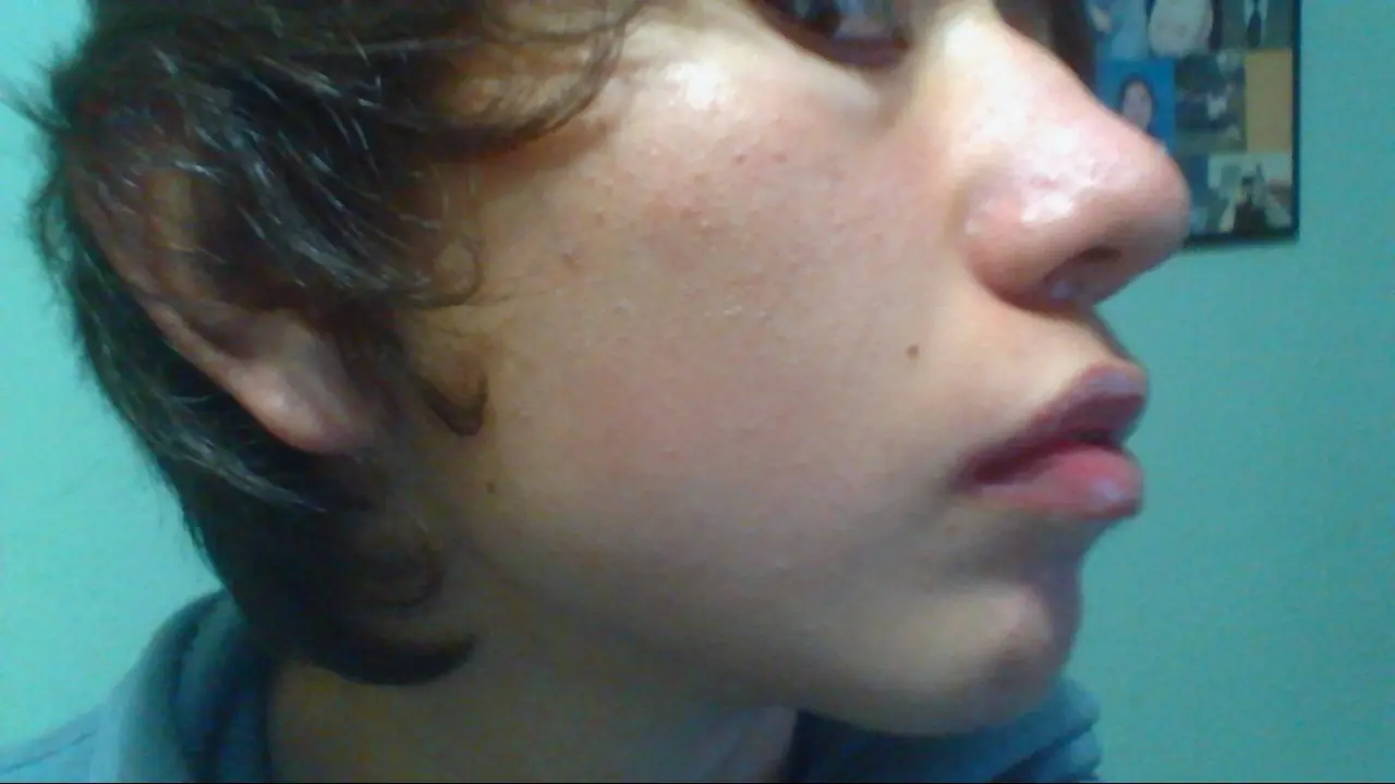 acne soluciones