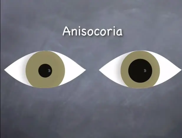 ¿Qué es la anisocoria? + Resumen nv 5