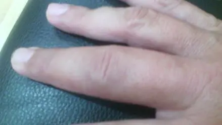 Estoy a punto de perder el uso de mi mano
