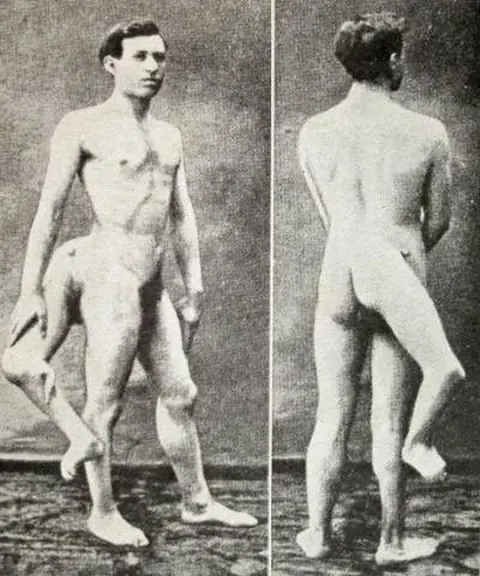 Frank Lentini , el hombre de las tres piernas