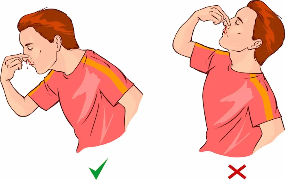 epistaxis