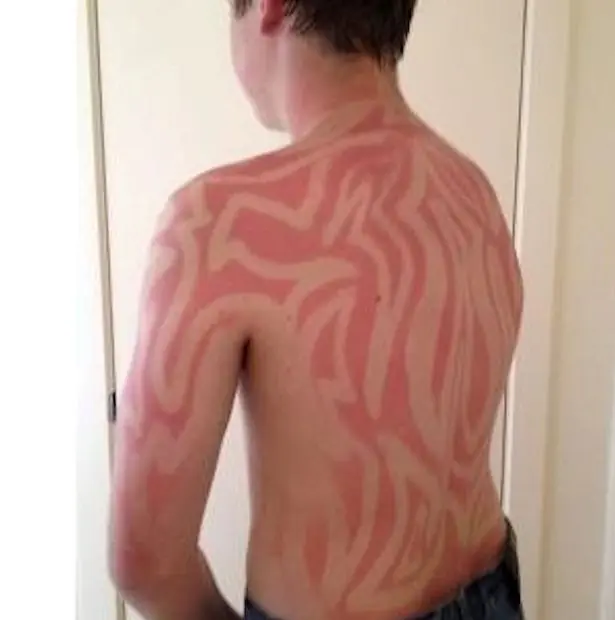 sunburn tattoos sunburn tattoos