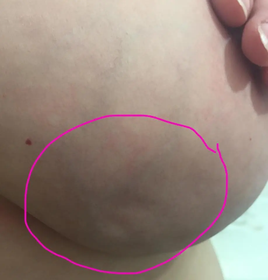 Así se ve un cáncer de mama