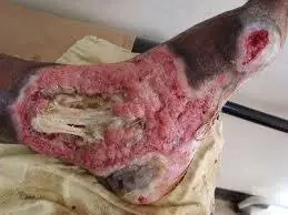 krokodil "droga zombie"