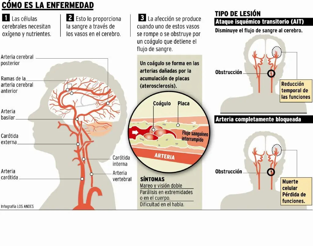 infarto cerebral