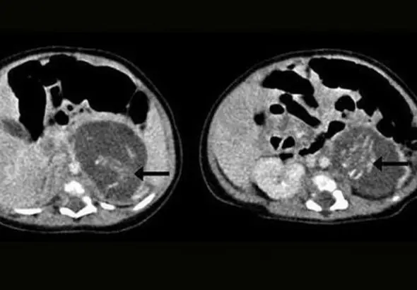 bebe embarazada? y de gemelos! chanfle