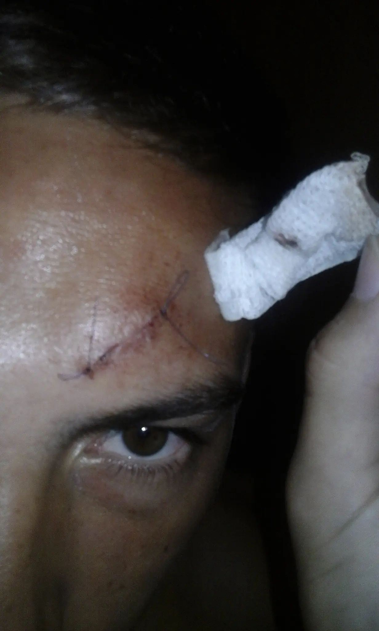 me duele el ojo perro