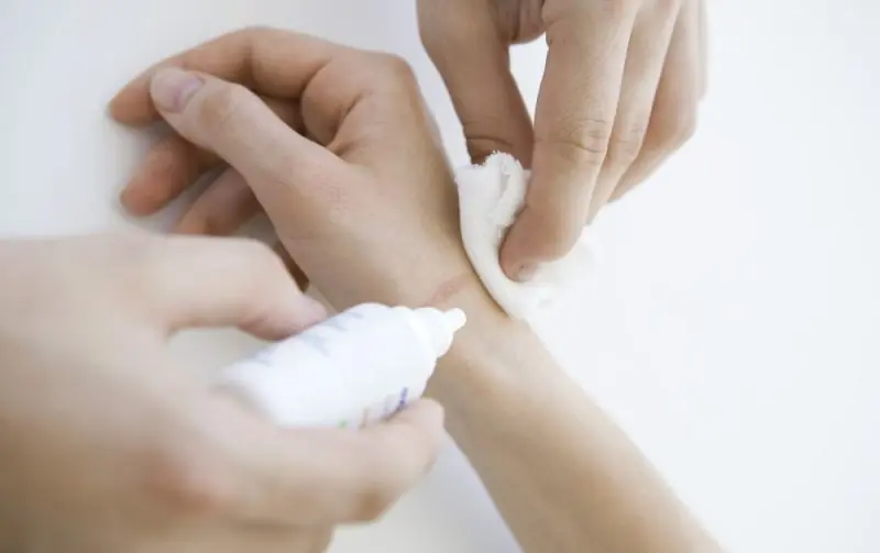 Porqué no deberías desinfectar tus heridas cn agua oxigenada