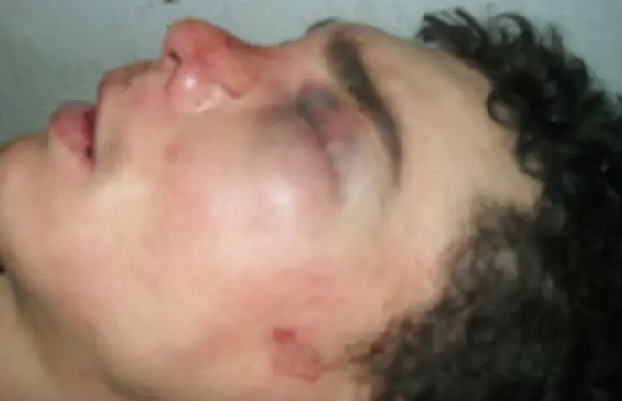 Patovicas desfiguraron a pibe en boliche de Claypole
