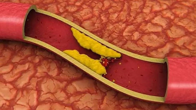 Médico Argentino, un hallazgo para prevenir infarto y ACV