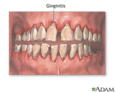 La Gingivitis_Articulo de Prevencion