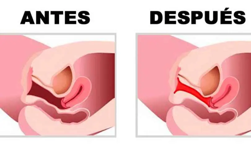 Lincesa cuida tu vagina luego de una relacion Sexual