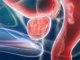 Desarrollan Modelo para Tratar el Cancer de Prostata