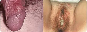 Infecciones de Transmisión sexual
