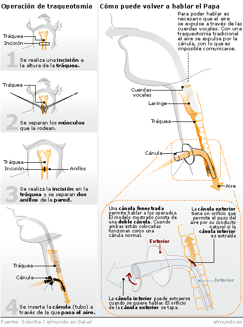 ¿Qué es una traqueotomía?