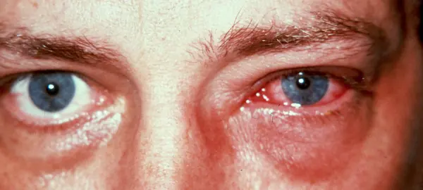 conjutivitis