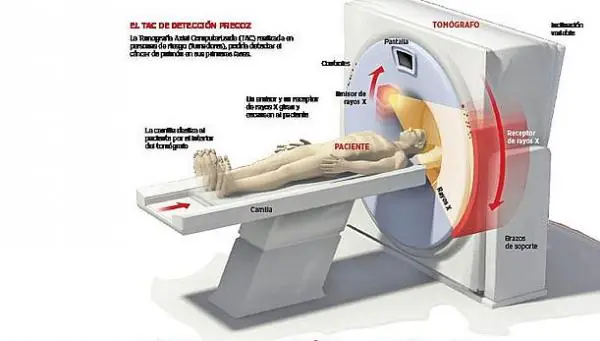 Neurofibromatosis II (la enfermedad silenciosa)