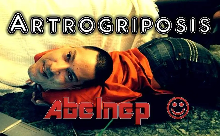 artrogriposis