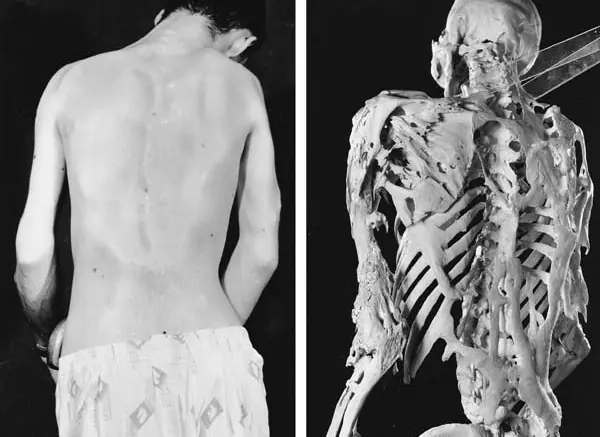 Conoces el síndrome del hombre piedra? Te lo explico nvl 10