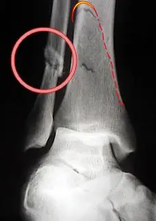 fracturas