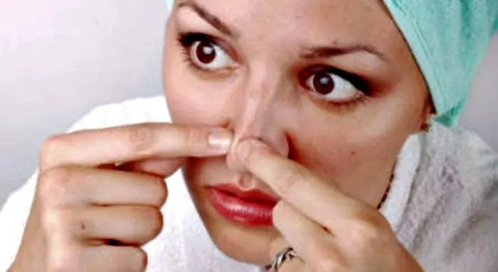 Acné y puntos negros.