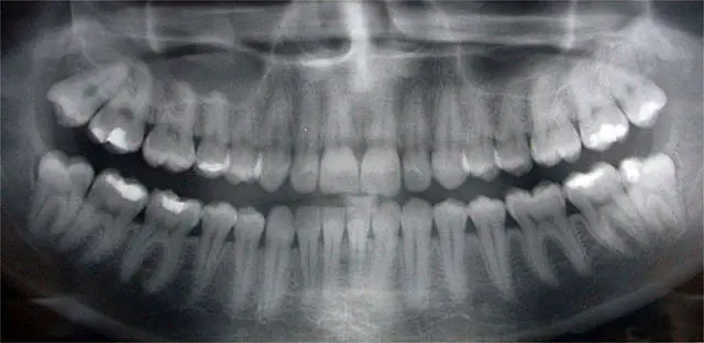 revision dental