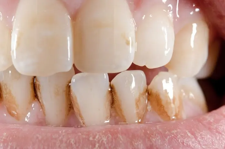 dientes