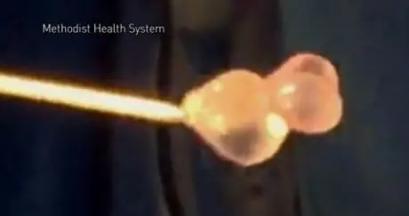 Mujer  dolor cabeza; no creerás lo que había en su cerebro