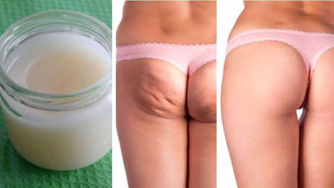 Quita las estrías y la celulitis fácil