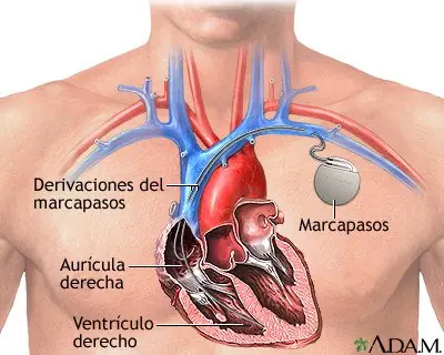 Lo Que Debe Saber si le Implantan Un Marcapasos en el Pecho