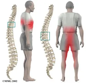 hernia discal