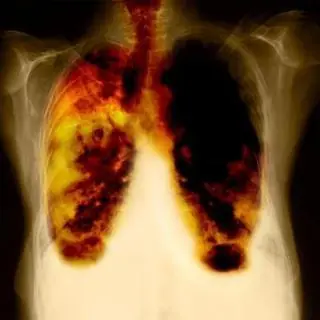 Fumar
