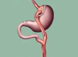 Bypass Gástrico cura la Diabetes - Dr. Raúl Layme Arias