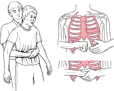 Heimlich en obesos