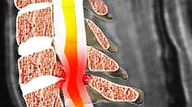 Cambios cerebrales por la compresión medular