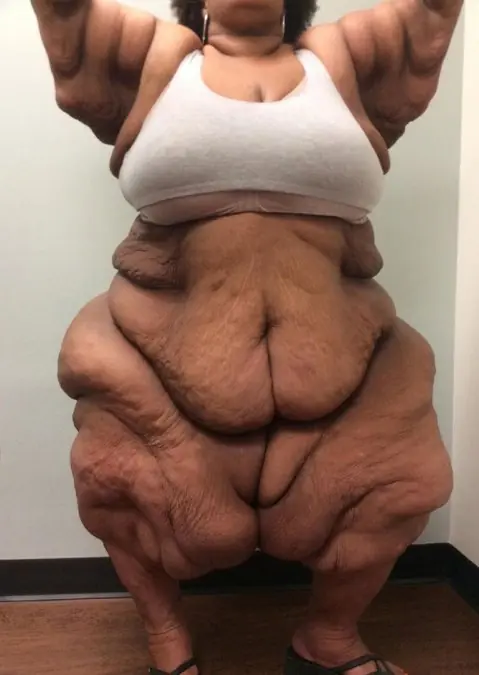obesa obesa