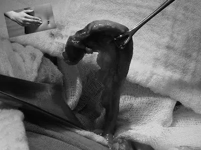 peritonitis