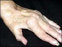 Una copa diaria para la artritis