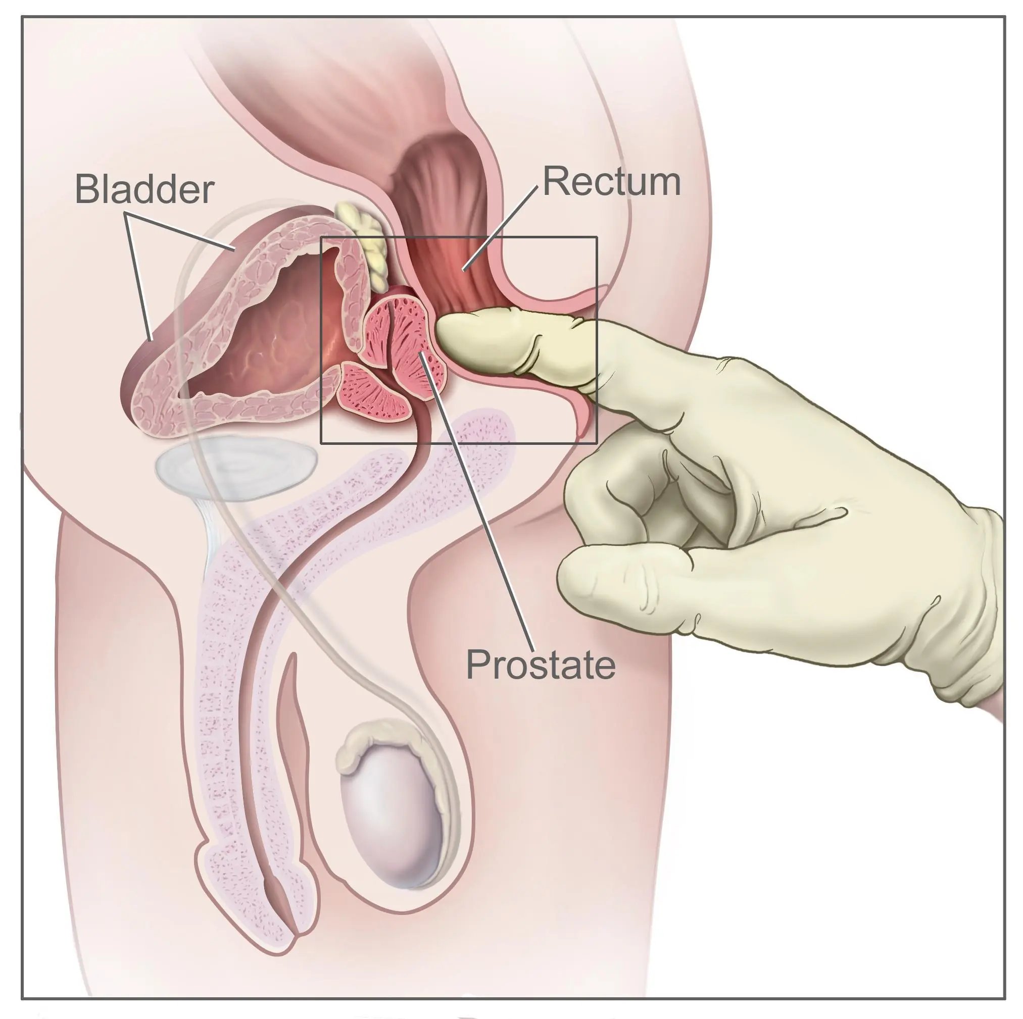 Mi historia horrible jamas contada (prostata)