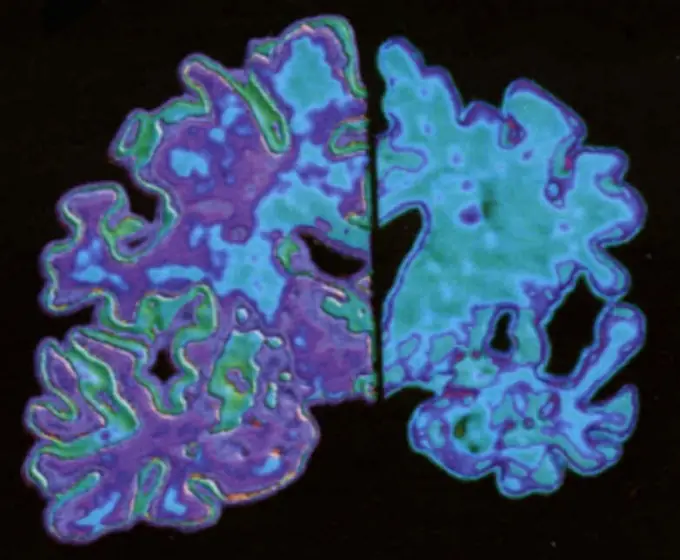 ¿En que consiste realmente la enfermedad del Alzheimer?