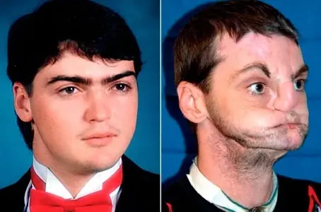 Se Disparo En El Rostro