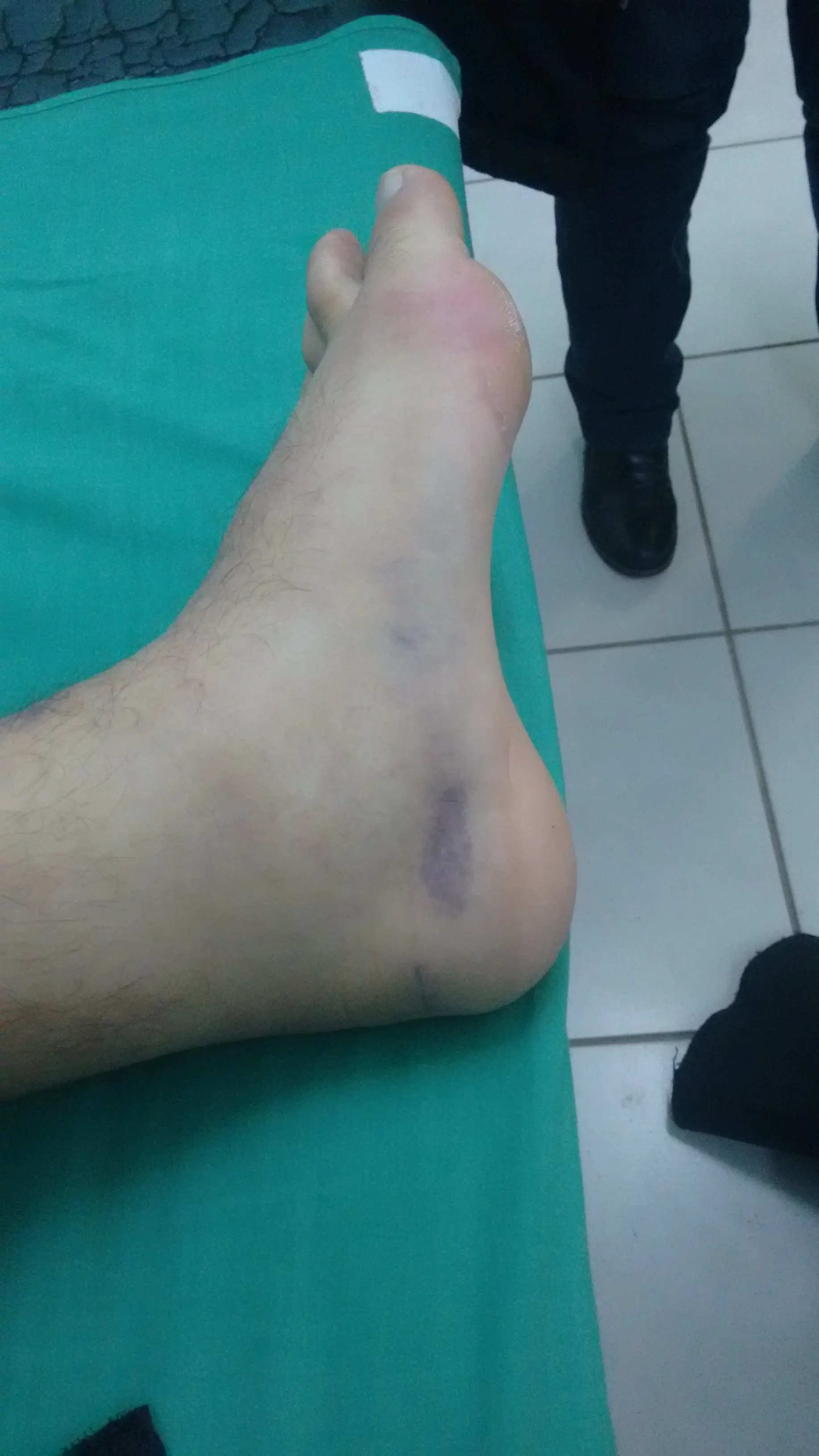 Esguince de tobillo:Tratamiento