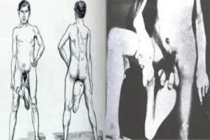 deformaciones humanas