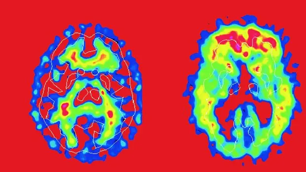 Medicamentos para menstruación servirian para el alzheimer
