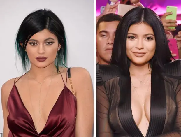 Kylie Jenner antes y después de operaciones