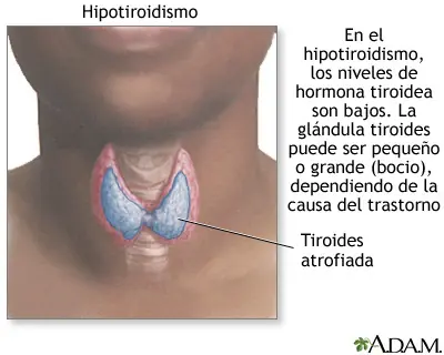 tiroides