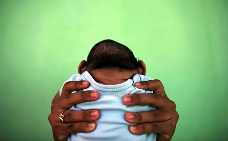 Colombia registra casos de microcefalia por zika