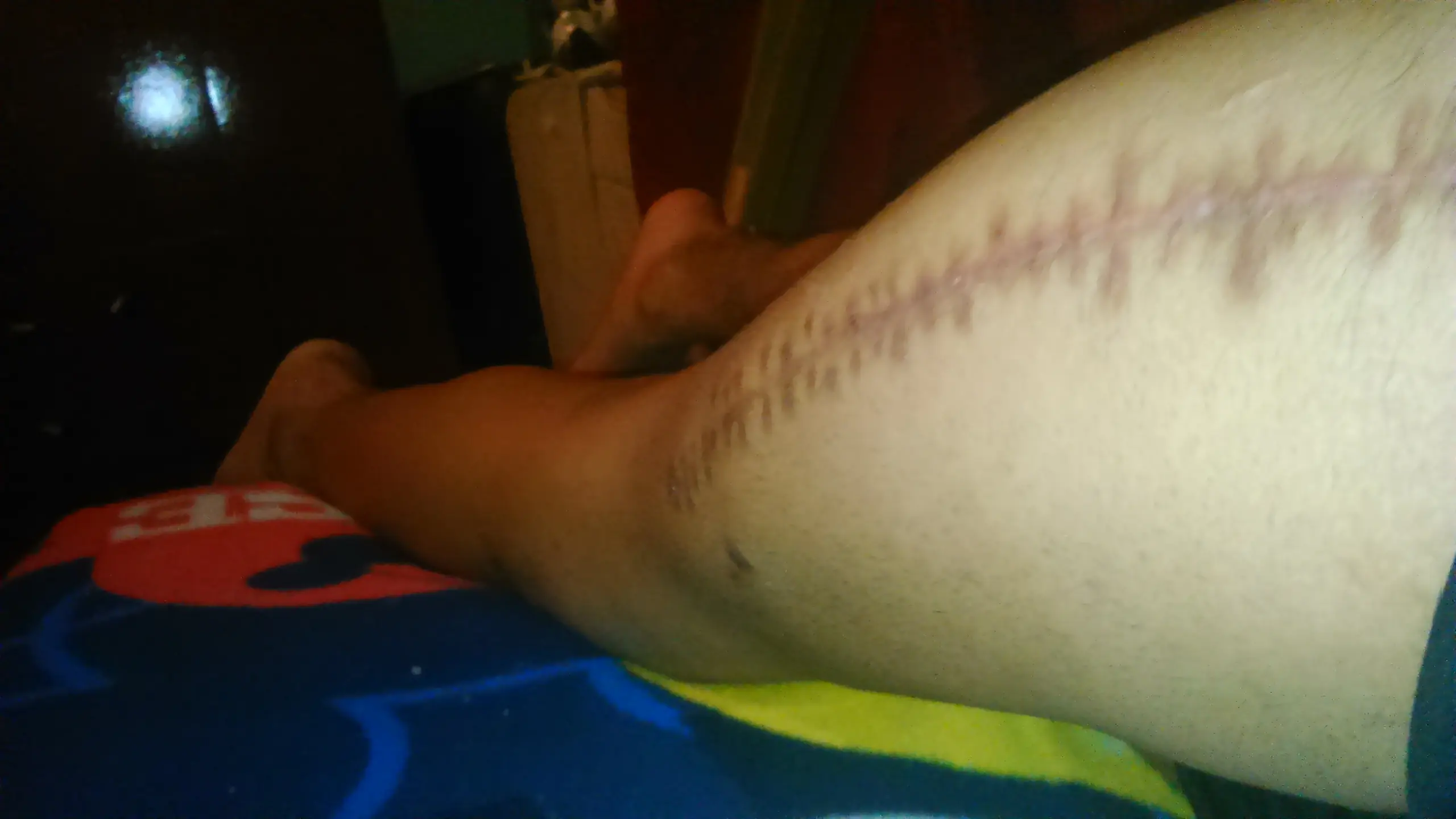 fracturas