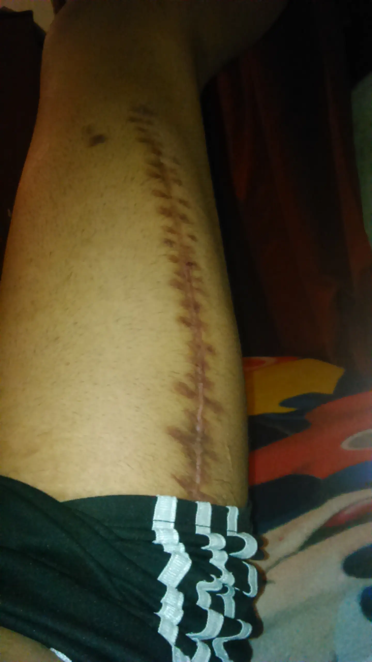 tube un accidente en moto q me arruino lo q queda de año